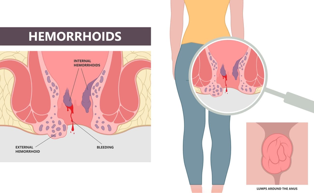 Laser Treatment for Piles / Hemorrhoids Treatment in Hyderabad