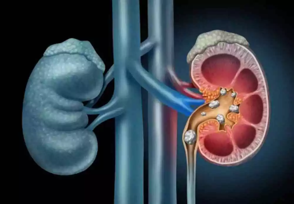 Understanding Kidney Disease: A Comprehensive Exploration
