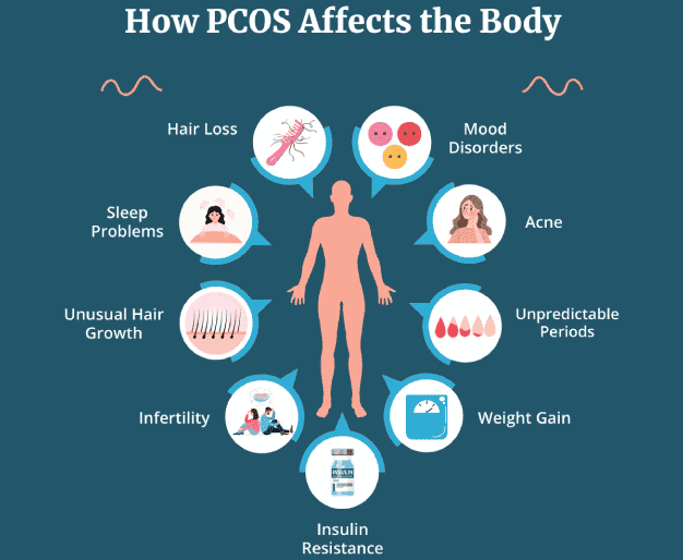 Managing PCOS Naturally: Diet, Exercise, and Holistic Approaches